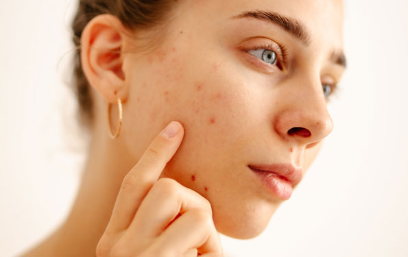 Amazin U - Acne & Acne Scarring What Causes
