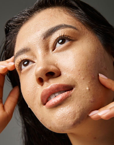Amazin U - Acne & Acne Scarring What Is