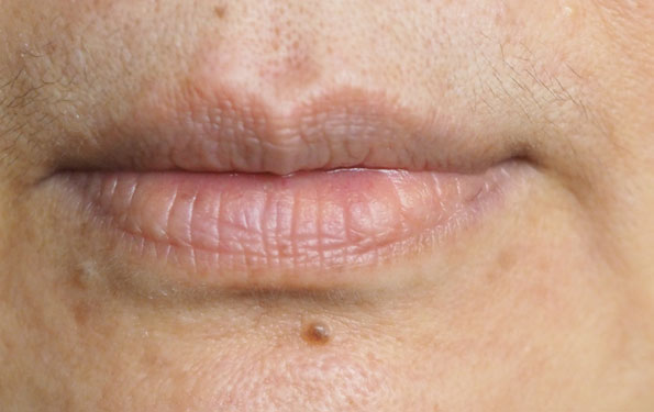 Amazin U - Gummy Smile What Causes