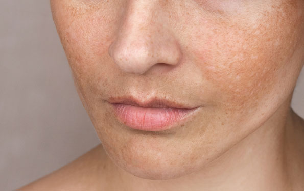 Amazin U - Melasma What Causes