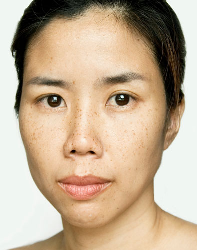 Amazin U - Melasma What Is