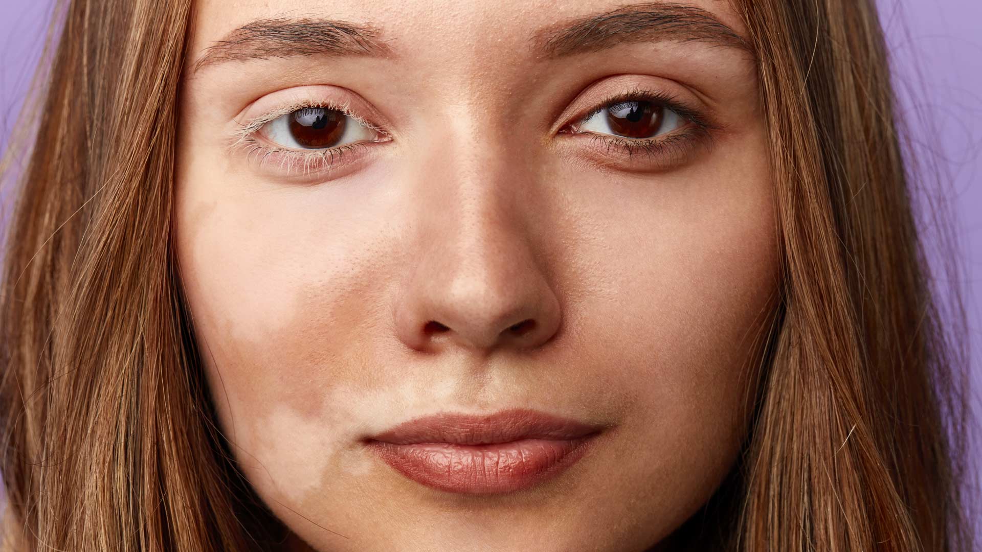 Amazin U - Pigmentation Disorders