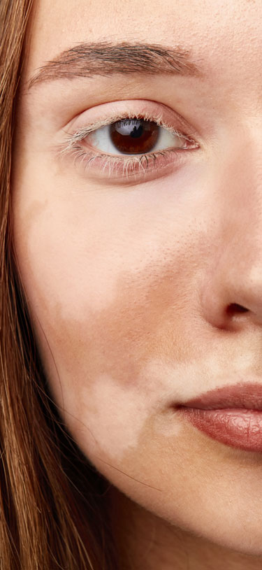 Amazin U - Pigmentation Disorders