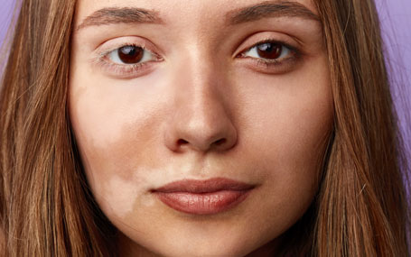 Amazin U - Pigmentation Disorders