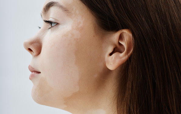 Amazin U - Pigmentation Disorders What Causes