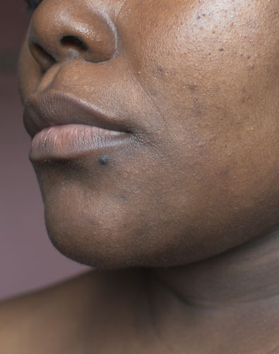 Amazin U - Pigmentation Disorders What Is