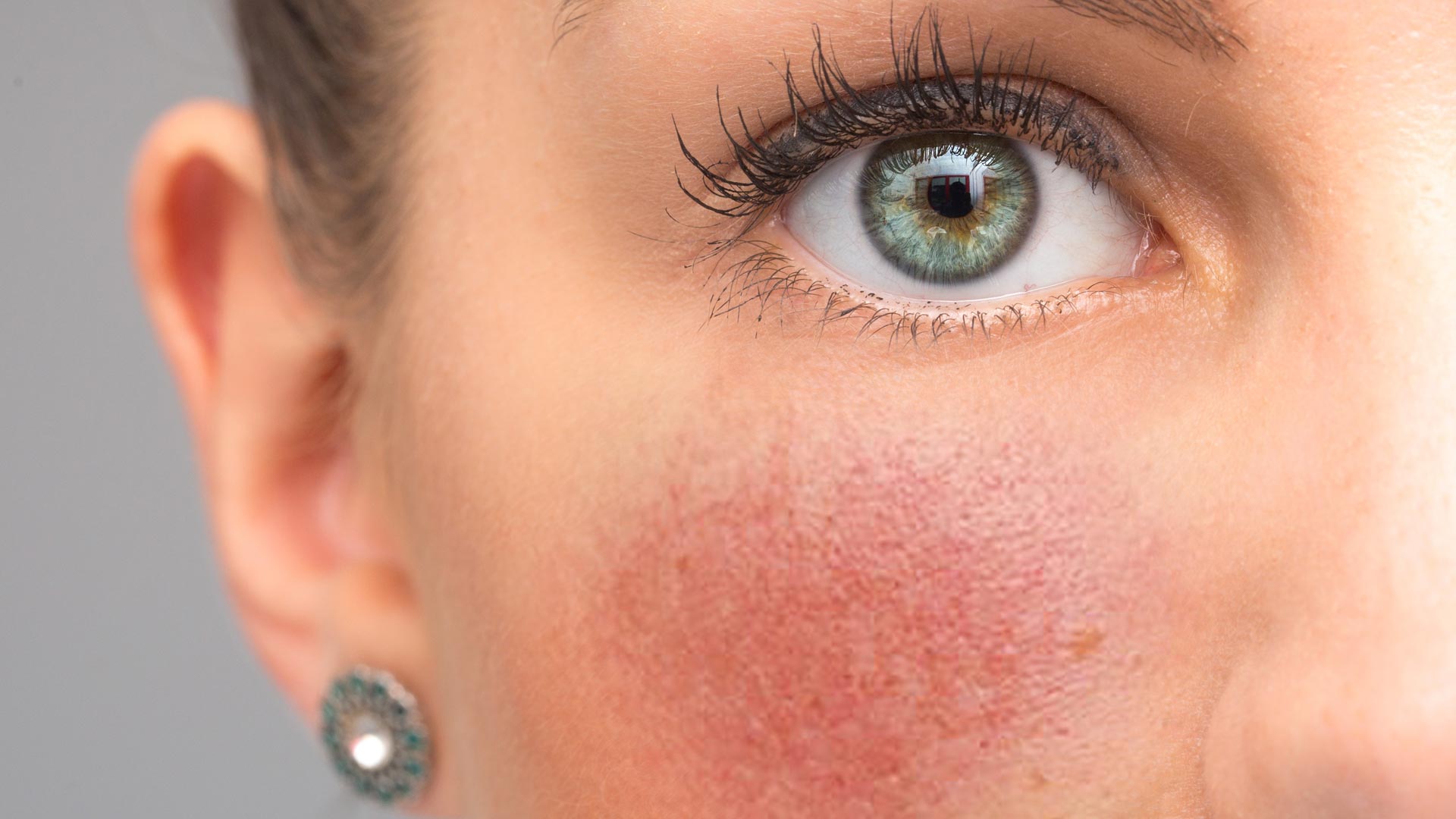 Amazin U - Rosacea & Facial Redness