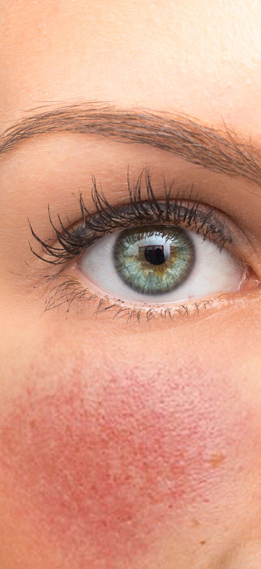 Amazin U - Rosacea & Facial Redness