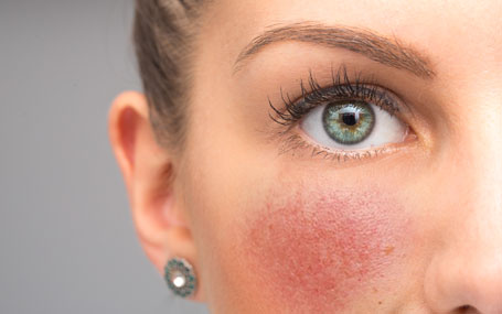 Amazin U - Rosacea & Facial Redness