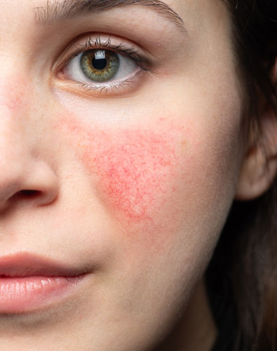 Amazin U - Rosacea & Facial Redness What Is