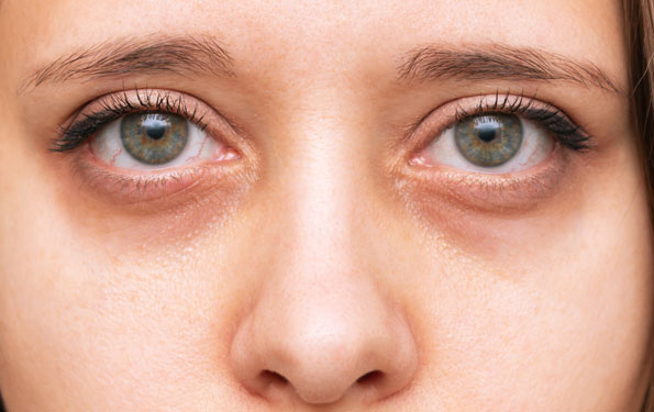 Amazin U - Under Eye Dark Circles & Hollowing What Causes