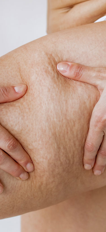 Amazin U - Cellulite & Uneven Body Skin Texture