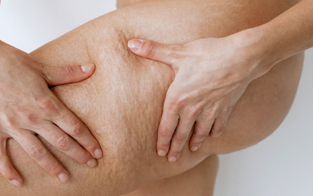 Amazin U - Cellulite & Uneven Body Skin Texture