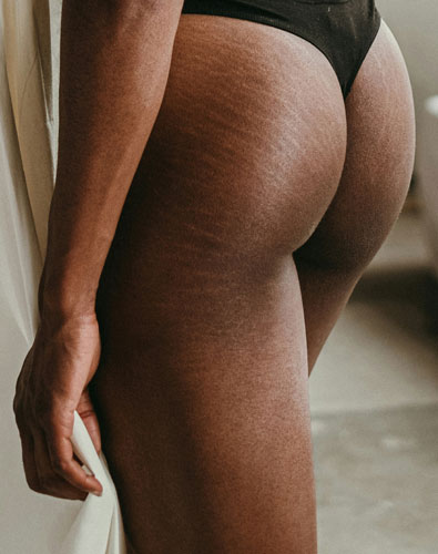 Amazin U - Cellulite & Uneven Body Skin Texture What Is
