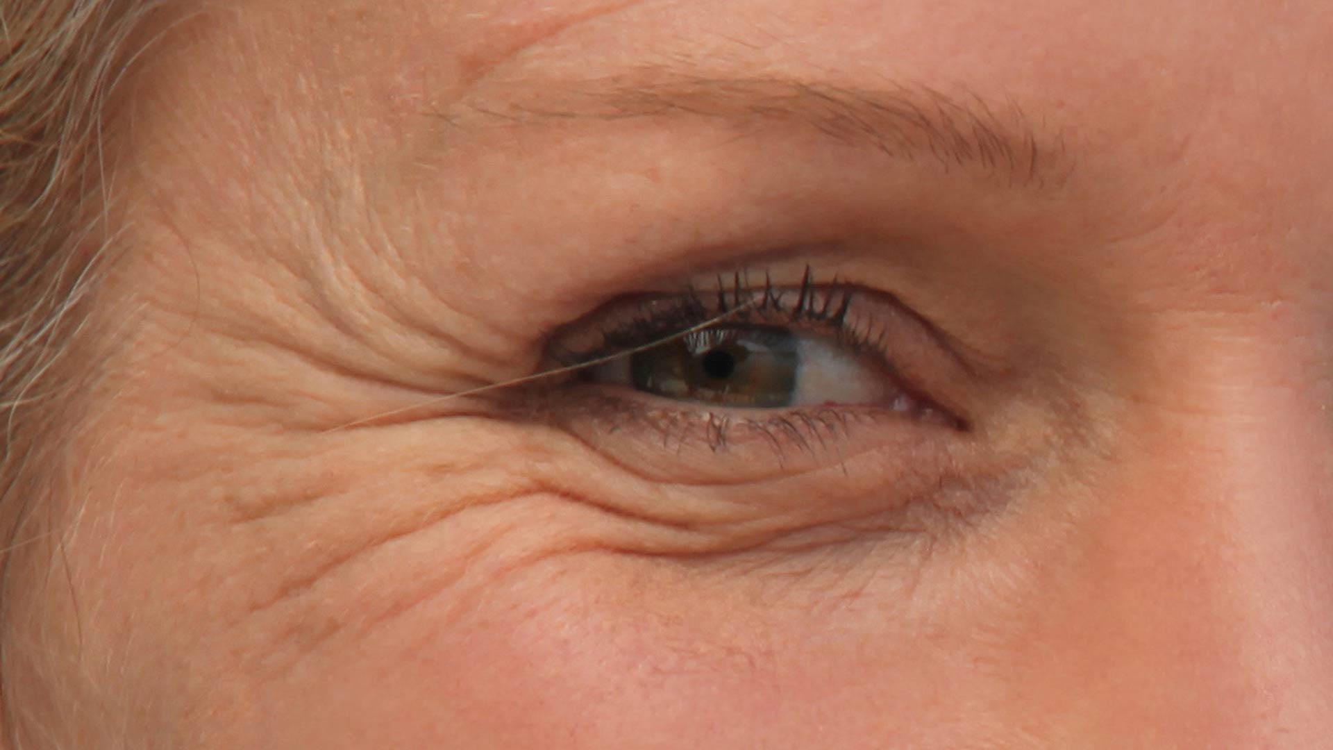 Amazin U - Crow’s Feet (Wrinkles Around The Eyes)