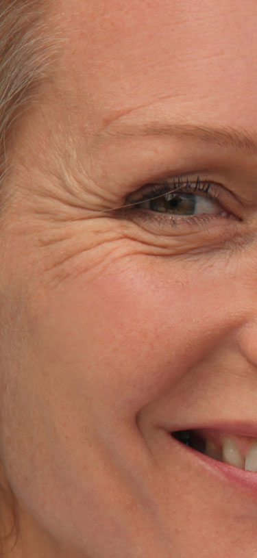 Amazin U - Crow’s Feet (Wrinkles Around The Eyes)