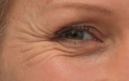 Amazin U - Crow’s Feet (Wrinkles Around The Eyes)