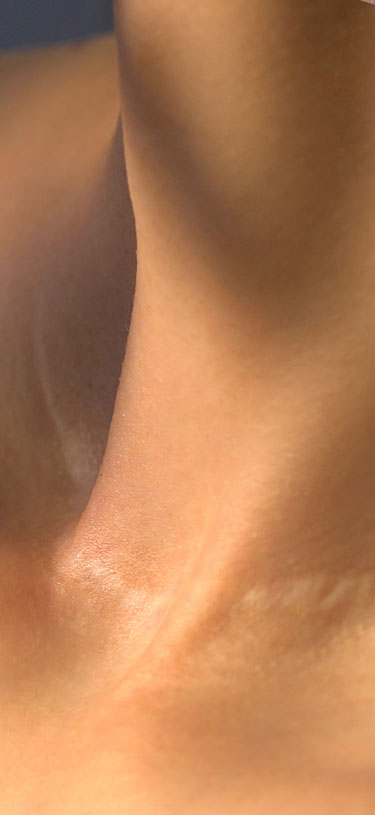 Amazin U - Stretch Marks & Scars