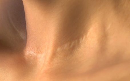 Amazin U - Stretch Marks & Scars