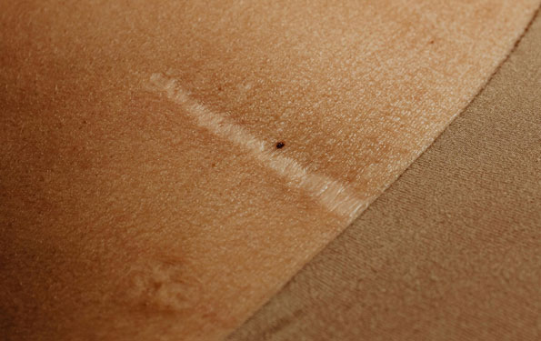 Amazin U - Stretch Marks & Scars What Causes