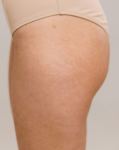 Amazin U - Stretch Marks & Scars What Is