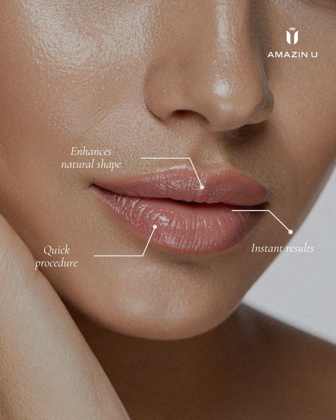 Lip Filler